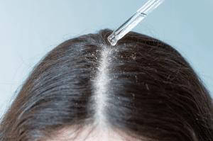 quels soins bio pour se débarrasser des pellicules